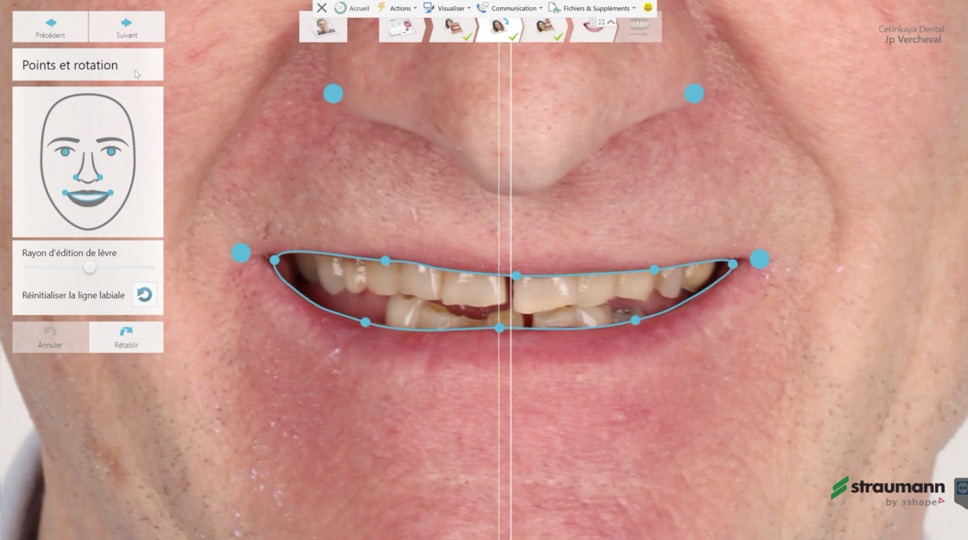 Digital Smile Design